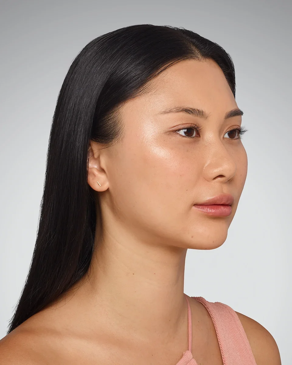 After Dermal Filler — cheeks