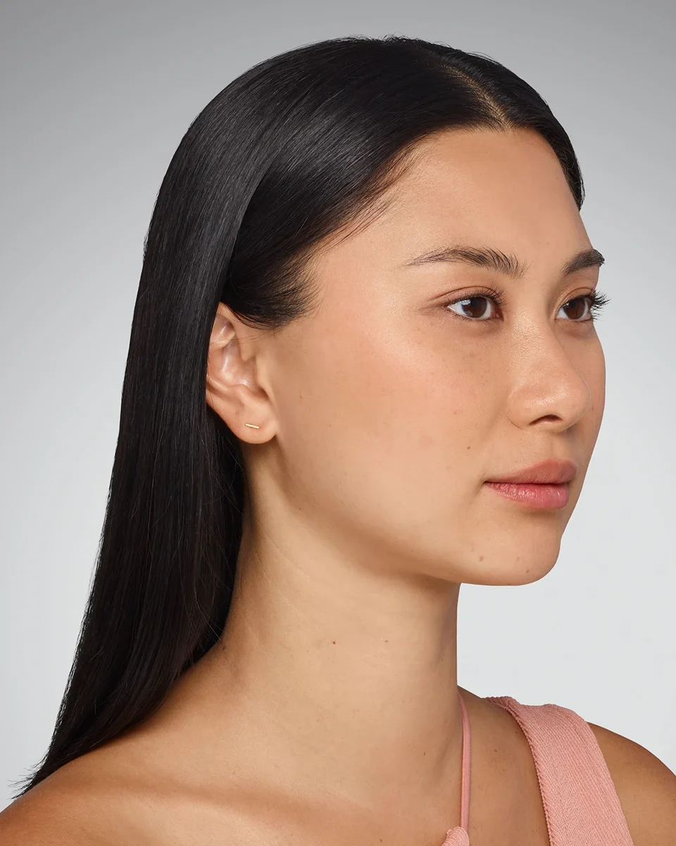 Before Dermal Filler — cheeks