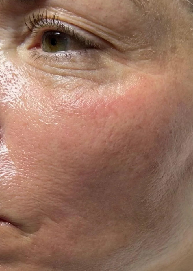 After HydraFacial + Dermaplane