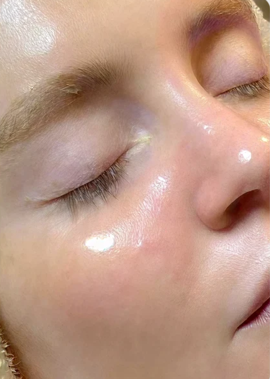 After HydraFacial + Dermaplane