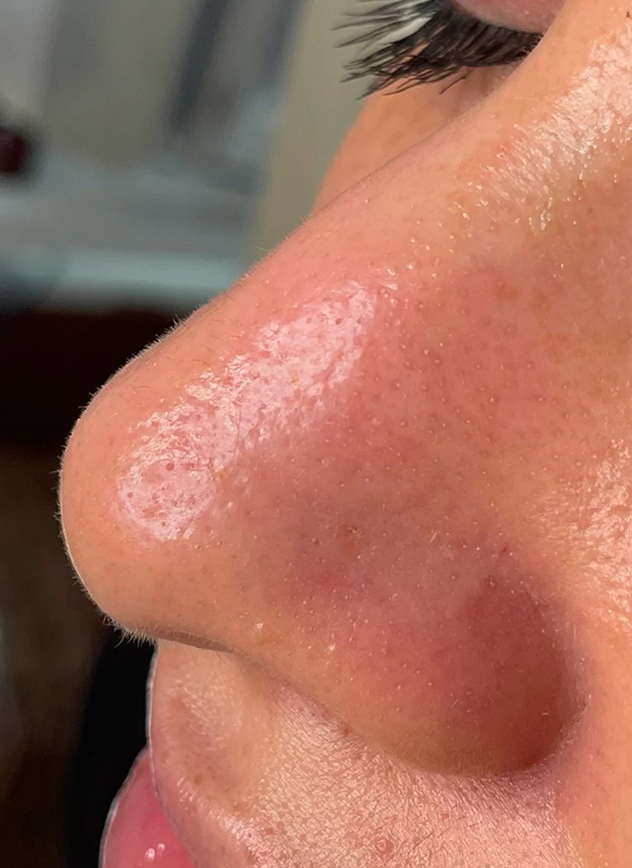After HydraFacial + Dermaplane