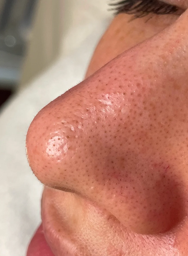 Before HydraFacial + Dermaplane