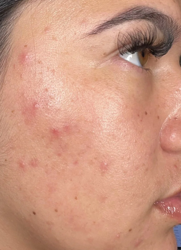 Before HydraFacial + Dermaplane