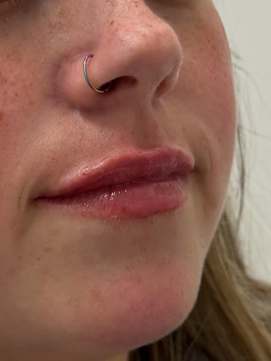 After Lip Filler