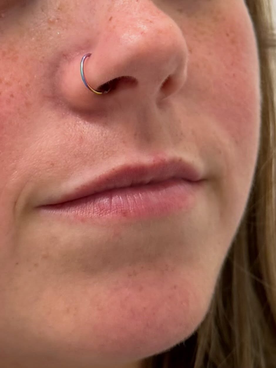 Before Lip Filler