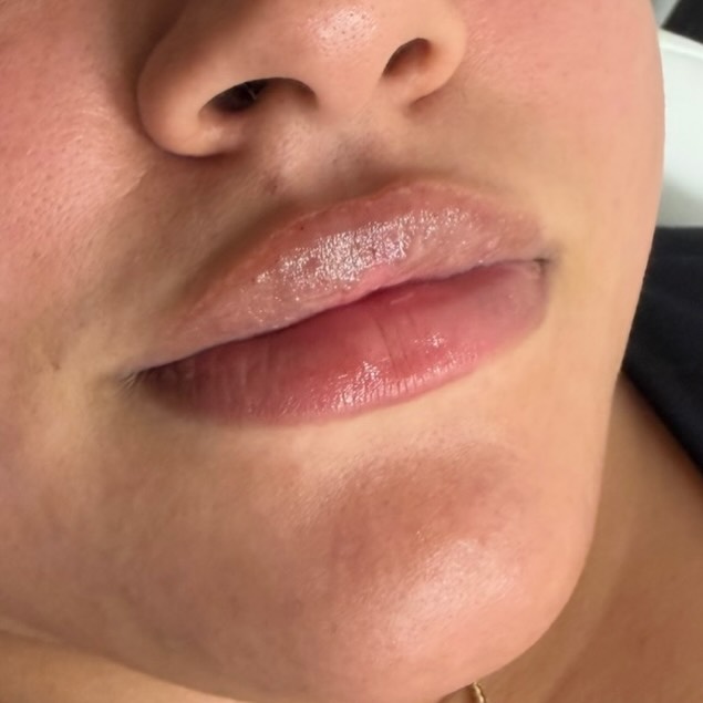 After Lip Filler