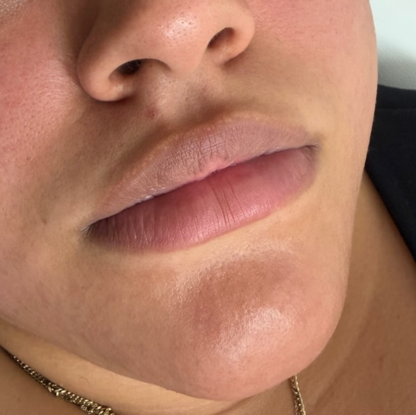 Before Lip Filler