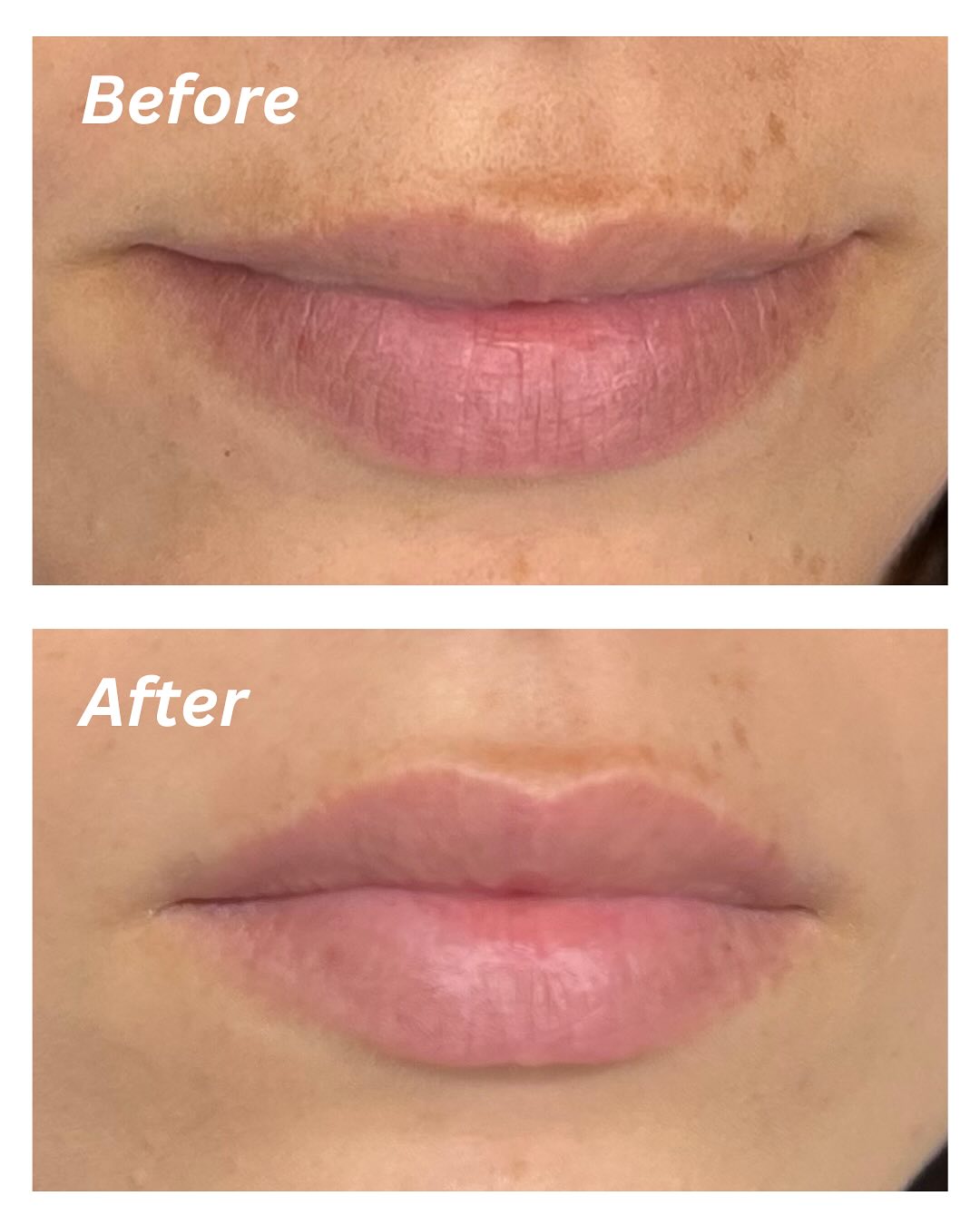 Lip Flip before and after