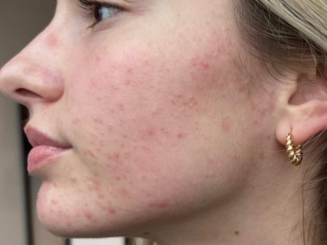 Before SkinPen Microneedling