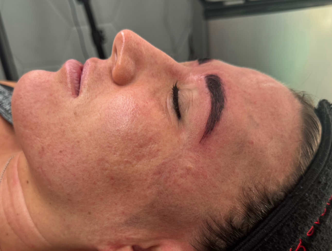 After SkinPen Microneedling