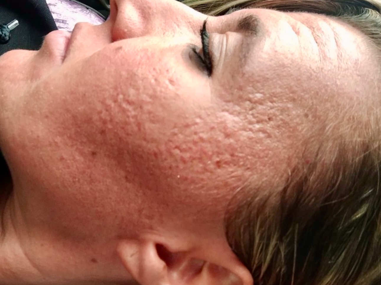 Before SkinPen Microneedling