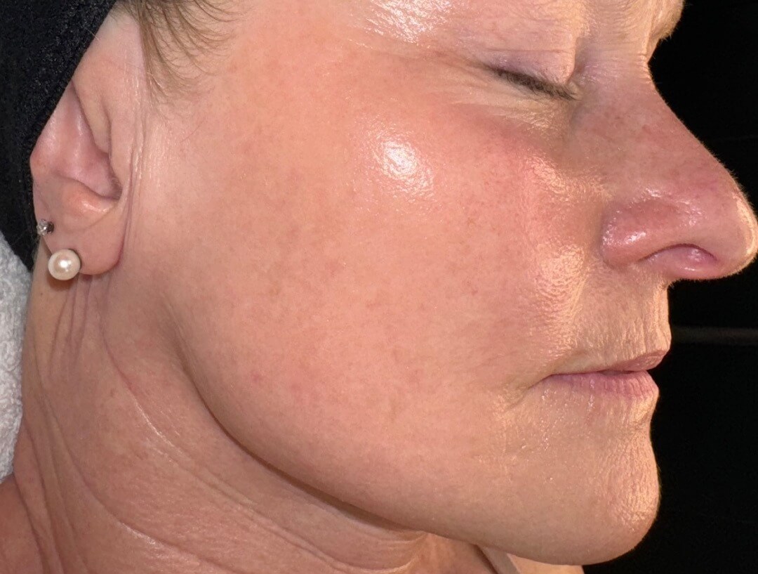 After SkinPen Microneedling