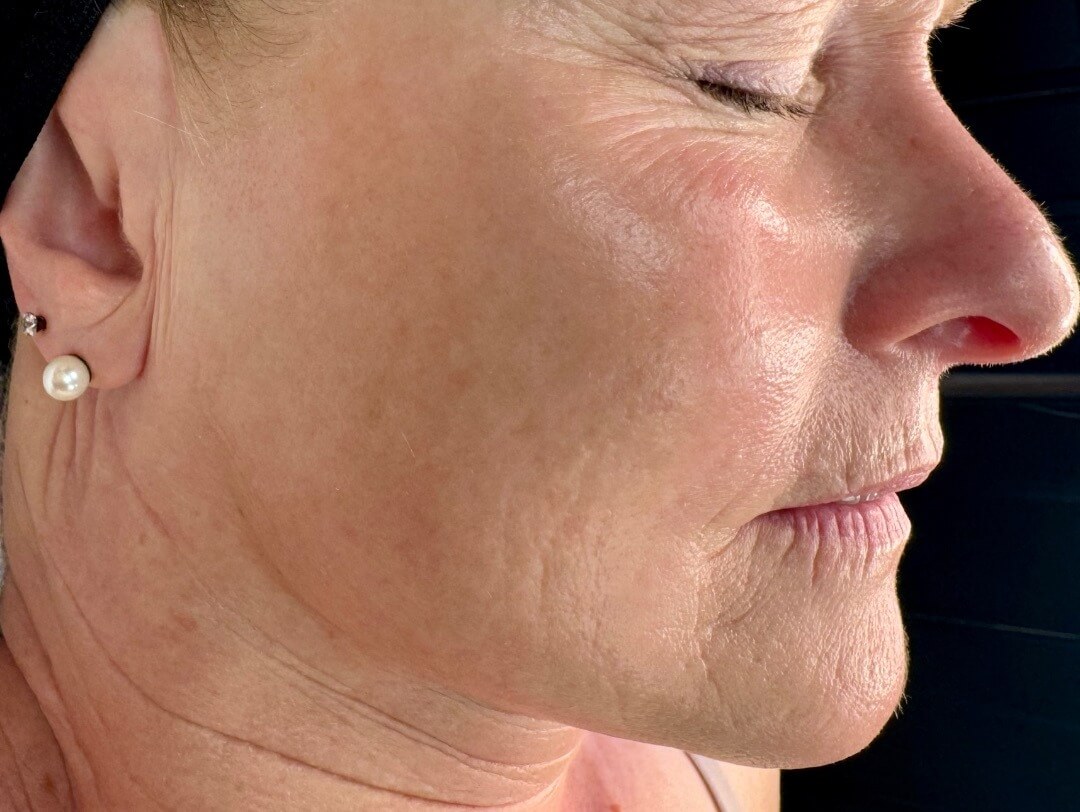 Before SkinPen Microneedling