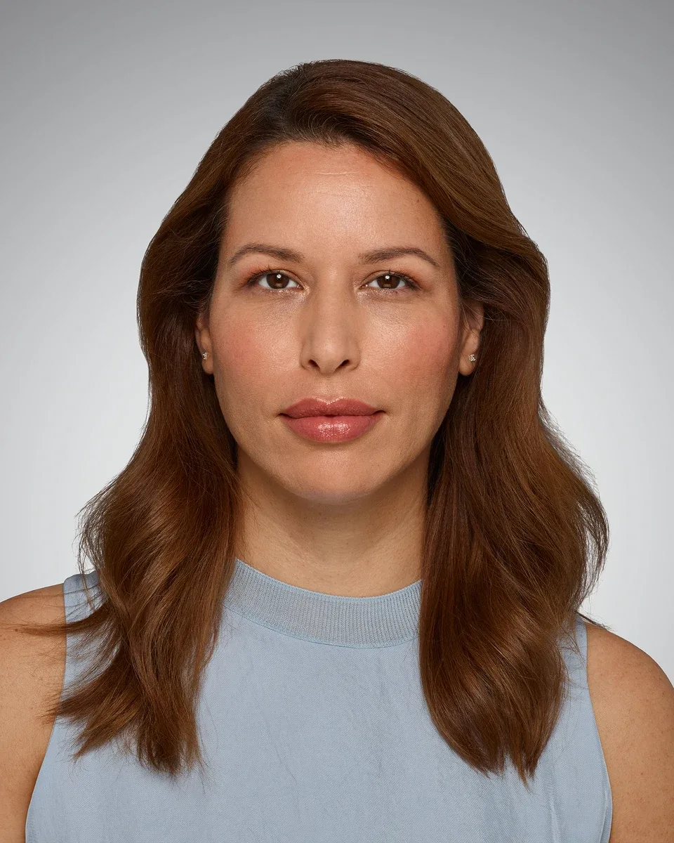 After Dermal Filler — smile lines