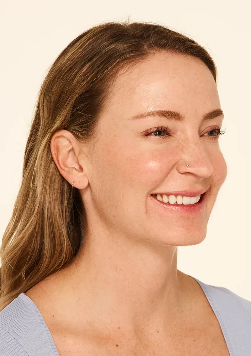 After Wrinkle Relaxers TOX