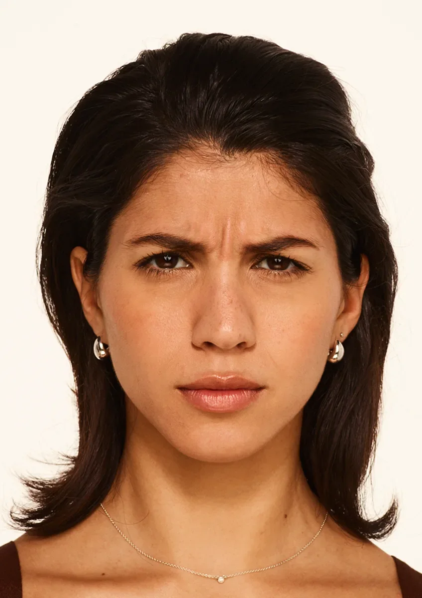 Before Wrinkle Relaxers TOX
